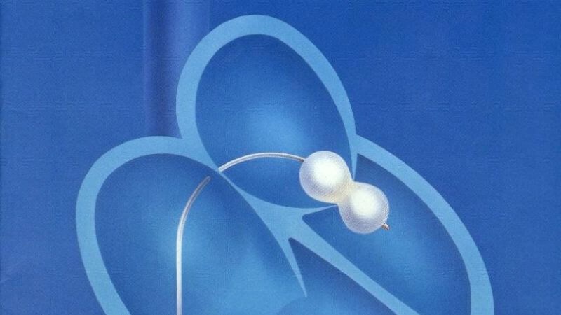 Nong bóng là thủ thuật hay được sử dụng để điều trị hẹp van hai lá