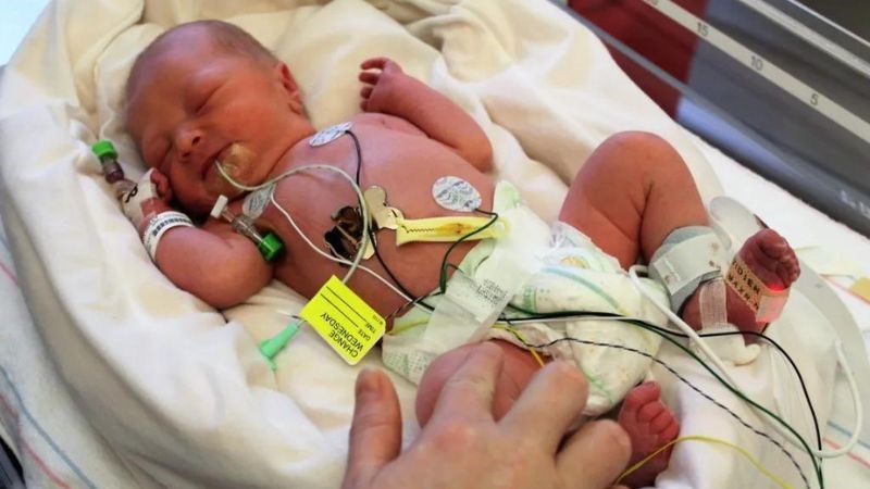 Viêm ruột hoại tử thường gặp ở trẻ sơ sinh non tháng Viêm ruột hoại tử thường gặp ở trẻ sơ sinh non tháng