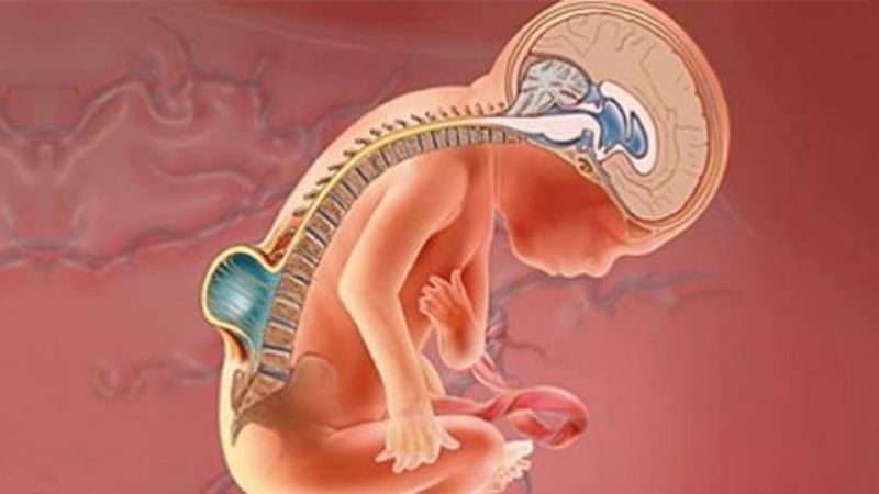 Tật nứt đốt sống là dị tật bẩm sinh có thể gây bàng quang thần kinh