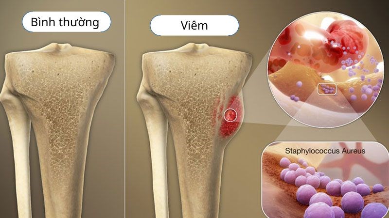Viêm tủy xương là tình trạng tủy xương bị các vi khuẩn tấn công