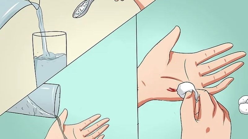 Vệ sinh sạch sẽ vết thương để tránh nhiễm khuẩn nặng hơn