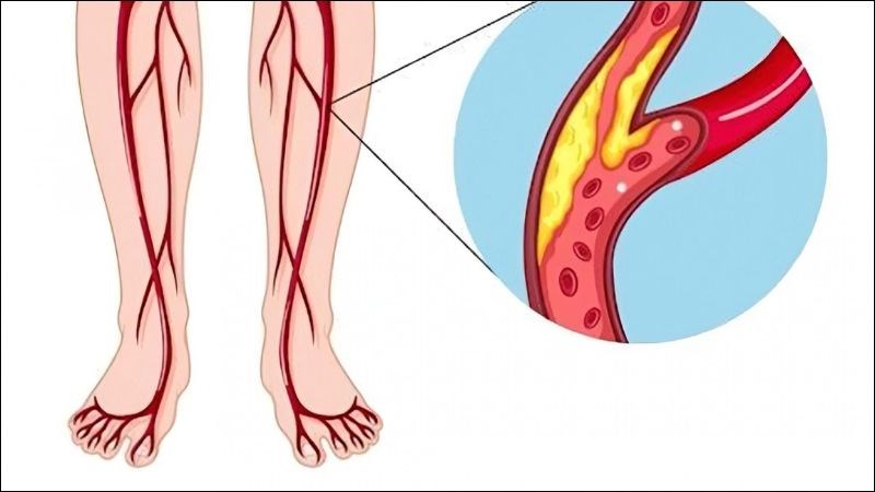 Bệnh động mạch ngoại biên ngăn cản dòng máu đến các cơ quan 
