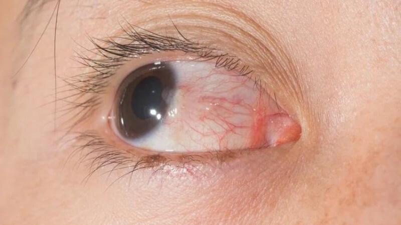 Mộng mắt là sự xuất hiện của một khối u trên kết mạc mắt