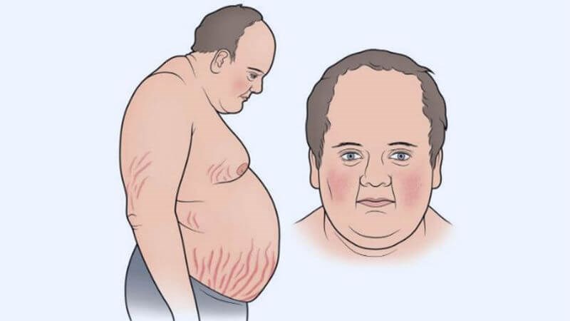 U tuyến yên gây ra bệnh Cushing