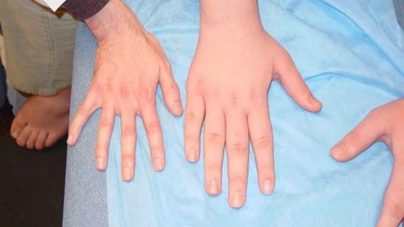 Tăng tiết quá nhiều hormone GH dẫn đến bệnh khổng lồ