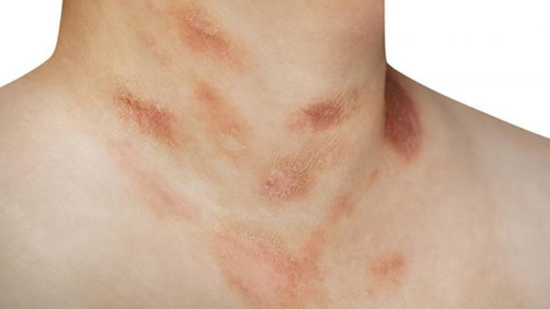 Tổn thương vảy phấn hồng thường gặp ở cổ, ngực, bụng
