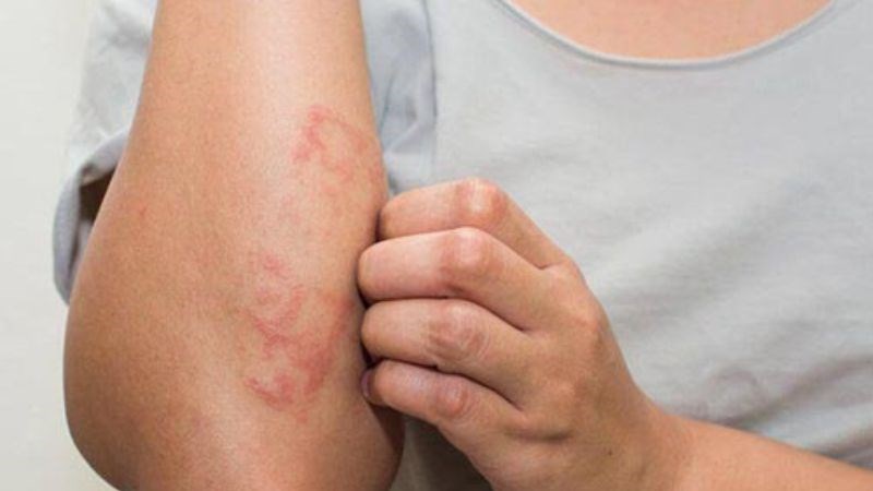 Biến chứng của bệnh có thể gây ngứa dữ dội
