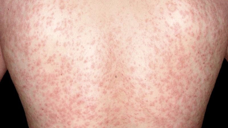 Phát ban lan rộng ở lưng trong bệnh vảy phấn hồng
