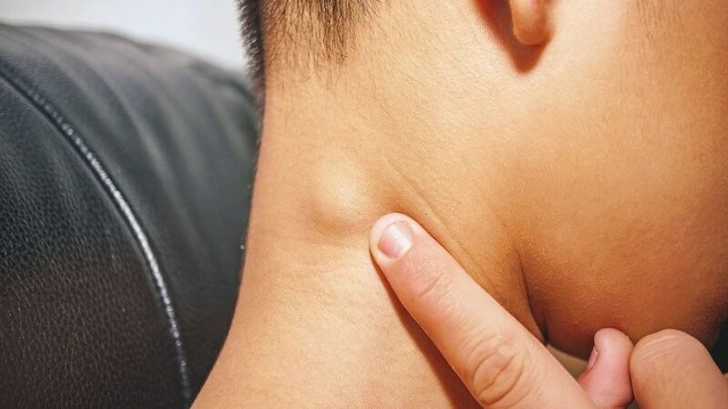 Triệu chứng đầu tiên của dịch hạch có thể là tình trạng sưng các hạch của cơ thể