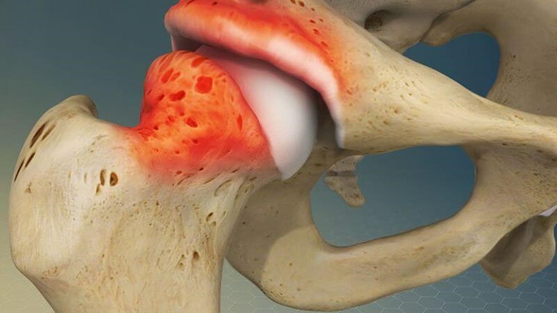 Viêm khớp háng là tình trạng thoái hóa hay bào mòn sụn khớp