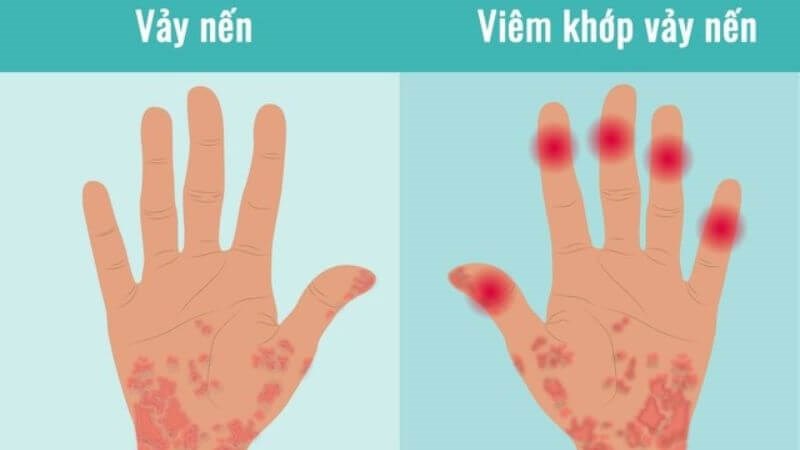 Viêm khớp vảy nến là tình trạng viêm khớp liên quan với bệnh vảy nến