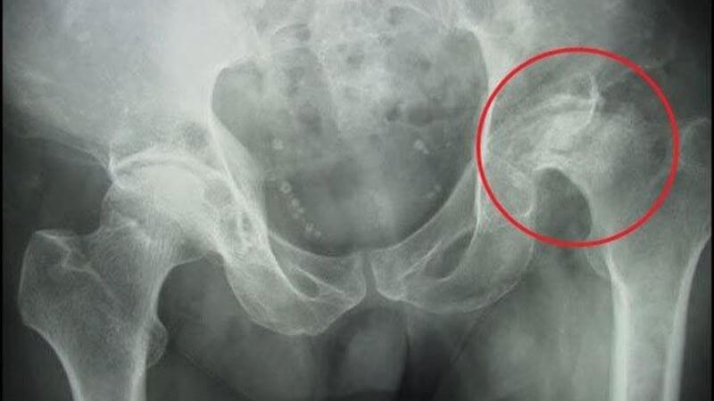 Hình ảnh X-quang gãy cổ xương đùi bên trái