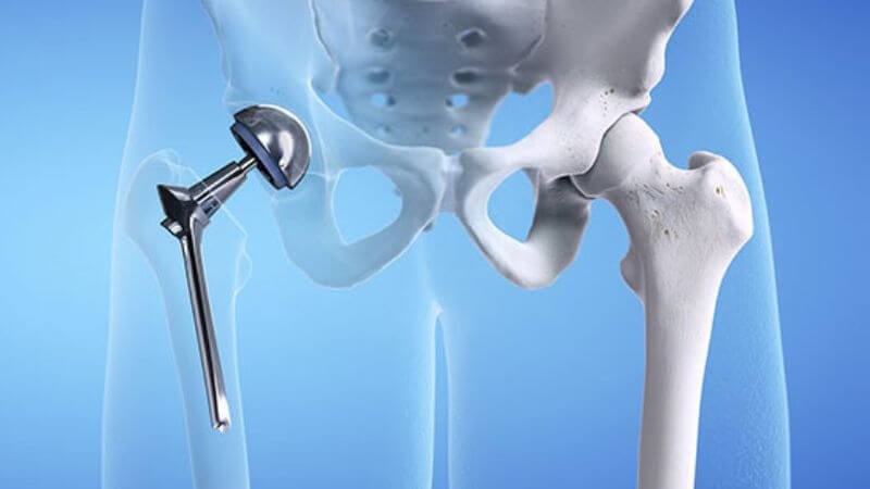 Thay khớp háng toàn phần có thể cải thiện tình trạng viêm khớp háng
