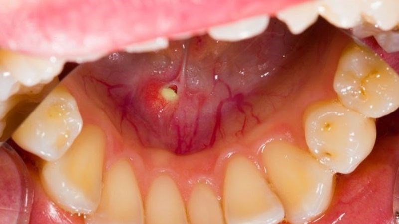 Sỏi tuyến nước bọt là những chất tích tụ và lắng đọng trong tuyến nước bọt