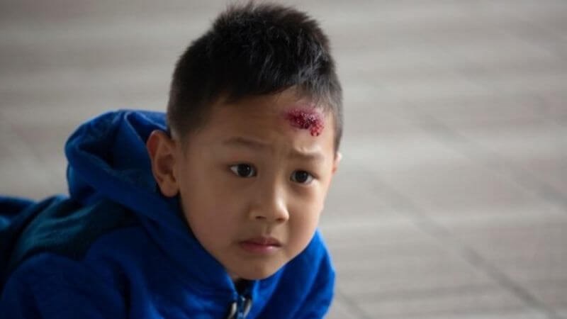 Ngã là một trong những nguyên nhân gây chấn thương sọ não