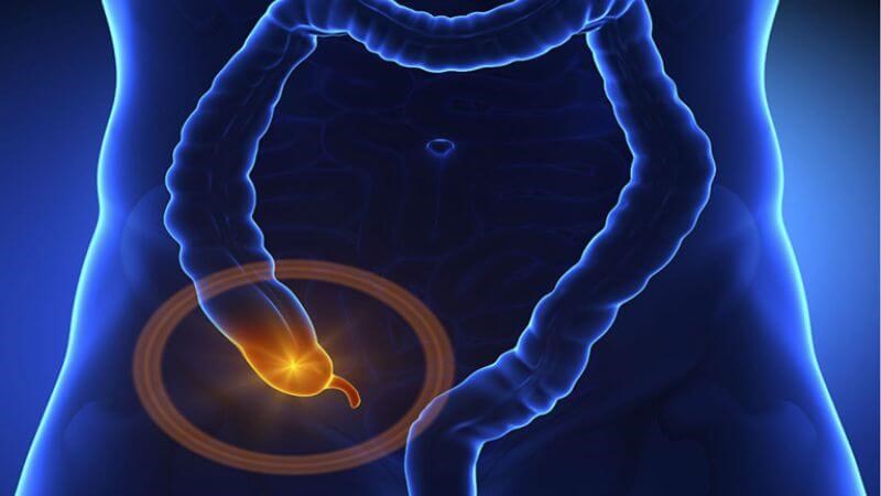 Viêm ruột thừa có thể gây nên tình trạng áp xe buồng trứng