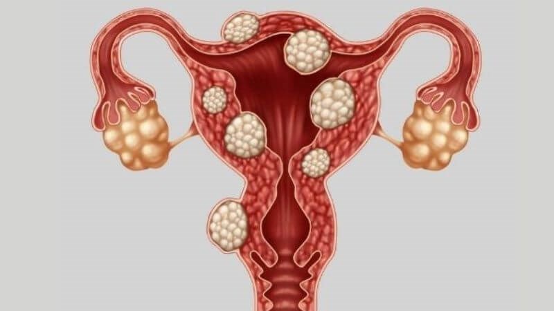 Người bị lạc nội mạc tử cung dễ mắc áp xe buồng trứng hơn những người khác