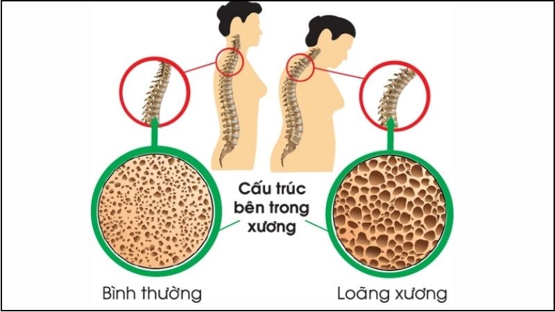 Loãng xương là nguyên nhân phổ biến của gãy đốt sống thắt lưng