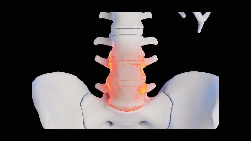 Gãy đốt sống thắt lưng sẽ có dấu hiệu đau lưng dữ dội