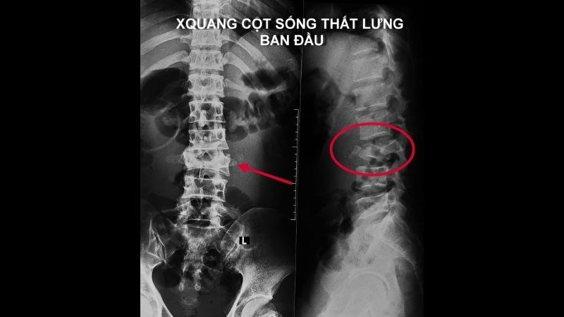 cần ít nhất một xét nghiệm hình ảnh để bác sĩ xác định rõ mức độ nghiêm trọng của tổn thương.