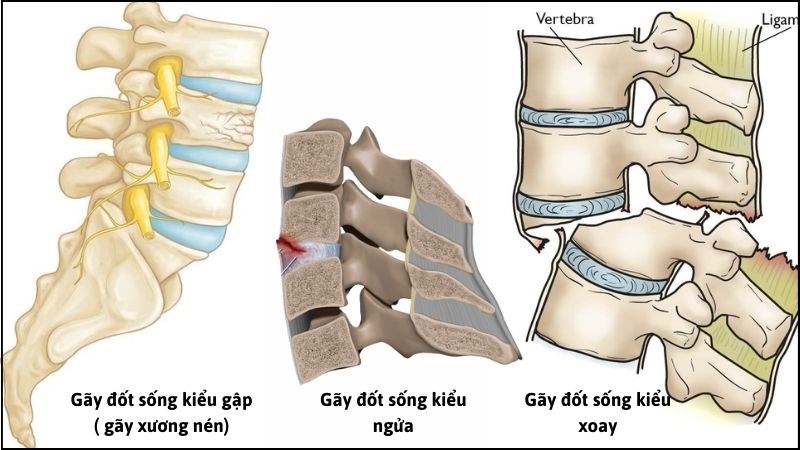 Gãy xương cột sống thắt lưng: Triệu chứng, sơ cứu và phương pháp điều trị