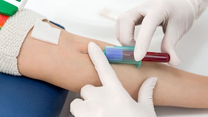 xét nghiệm máu 25-hydroxy vitamin D.