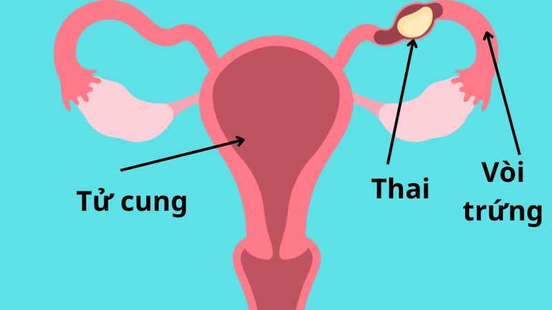 Viêm buồng trứng có thể gây ra thai ngoài tử cung