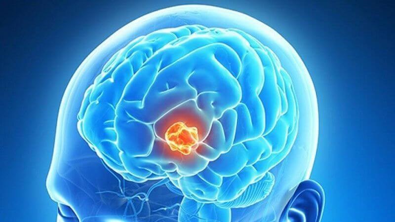 U não có thể là một nguyên nhân gây nên tình trạng đau đầu mạn tính