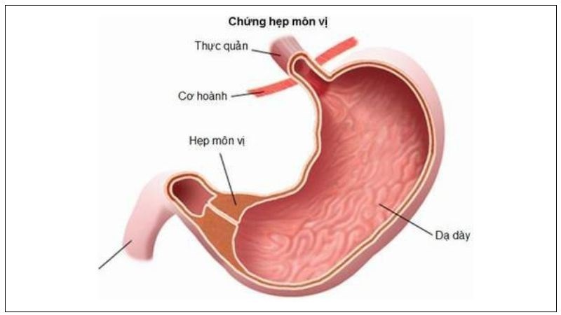Hẹp môn vị là sự tắc nghẽn hay trì trệ quá trình lưu thông thức ăn Hẹp môn vị là sự tắc nghẽn hay trì trệ quá trình lưu thông thức ăn