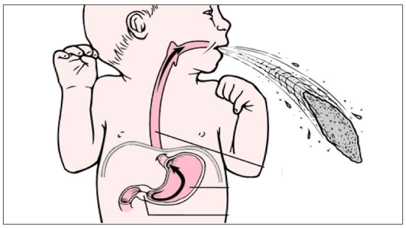 Nôn mửa là triệu chứng điển hình của hẹp môn vị Nôn mửa là triệu chứng điển hình của hẹp môn vị