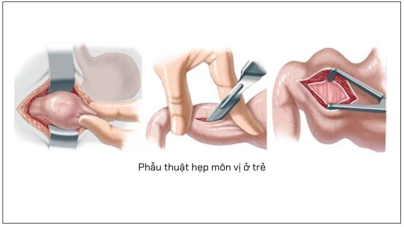 Điều trị hẹp môn vị bằng phẫu thuật đang là phương pháp được dùng phổ biến hiện nay Điều trị hẹp môn vị bằng phẫu thuật đang là phương pháp được dùng phổ biến hiện nay