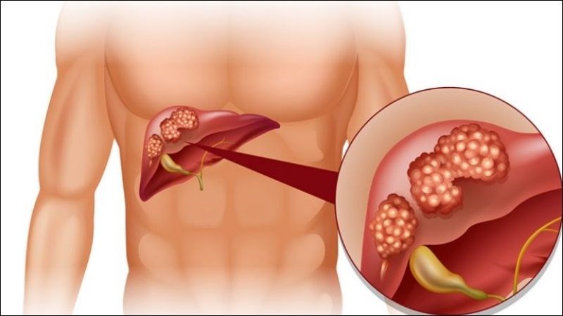 Bệnh nang gan hay còn gọi là u nang gan