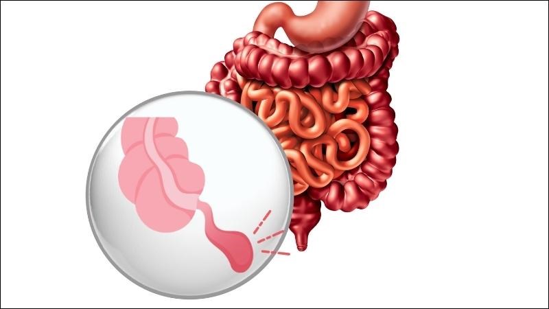 Viêm ruột thừa cấp là tình trạng viêm nhiễm cấp tính của ruột thừa