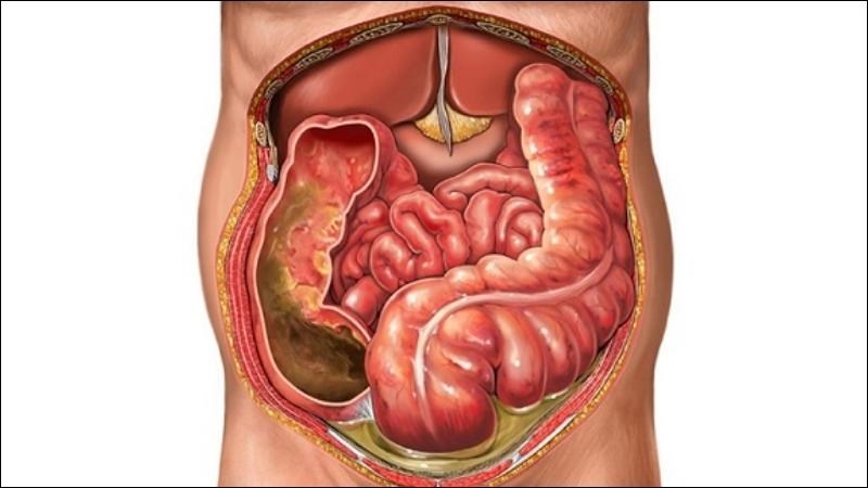Viêm ruột thừa cấp biến chứng viêm phúc mạc rất nguy hiểm