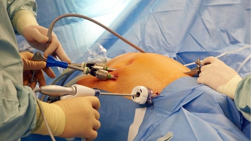 Phẫu thuật nội soi cắt ruột thừa để điều trị viêm ruột thừa cấp