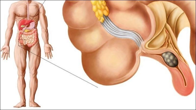 Nguyên nhân viêm ruột thừa được cho là do tắc nghẽn lòng ruột thừa