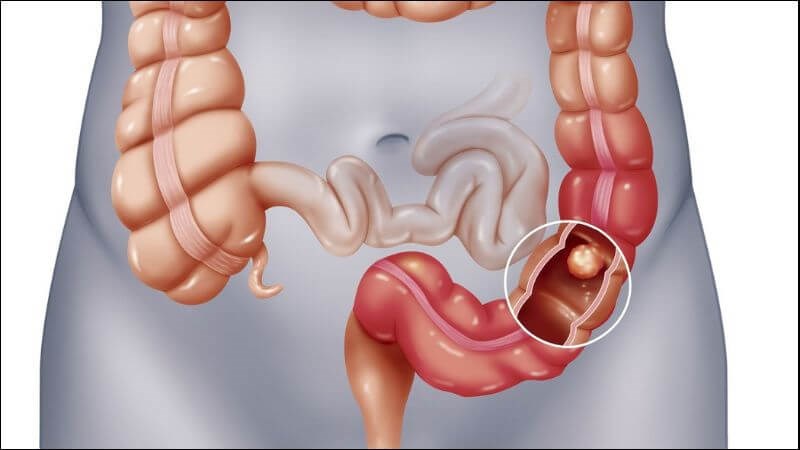 Búi giun tắc nghẽn có thể gây nên tắc ruột
