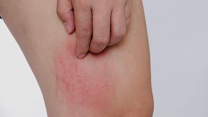 Phát ban nổi lên, đỏ ở đùi là dấu hiệu của bệnh