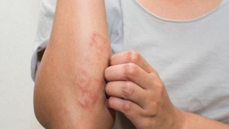 Hội chứng tăng nhiễm và giun lươn lan tỏa là các biến chứng nguy hiểm