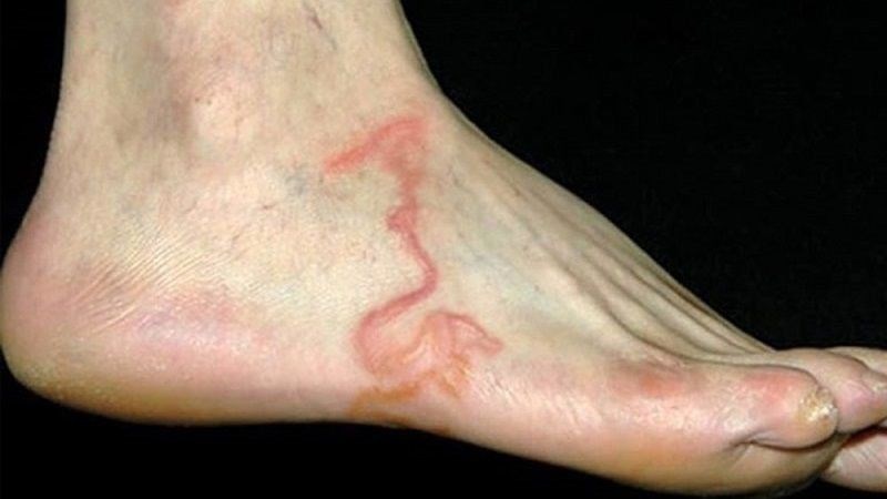 Bệnh giun lươn là bệnh nhiễm giun lươn Strongyloides stercoralis