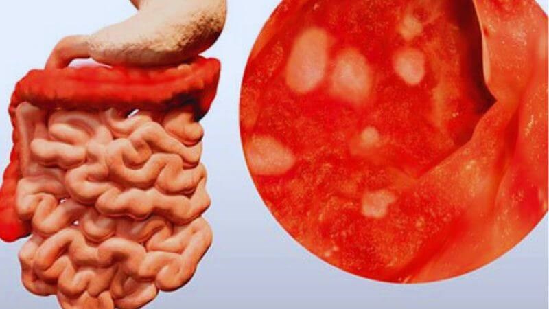 Người mắc viêm loét đại tràng có nguy cơ hình thành u đại tràng cao hơn 