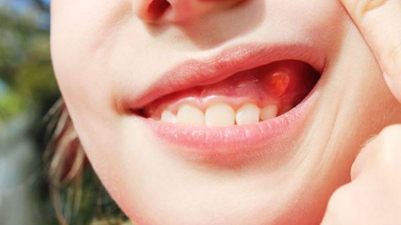 U răng là một tình trạng bệnh lý xuất phát từ các mô xương và mô cơ quan xung quanh răng