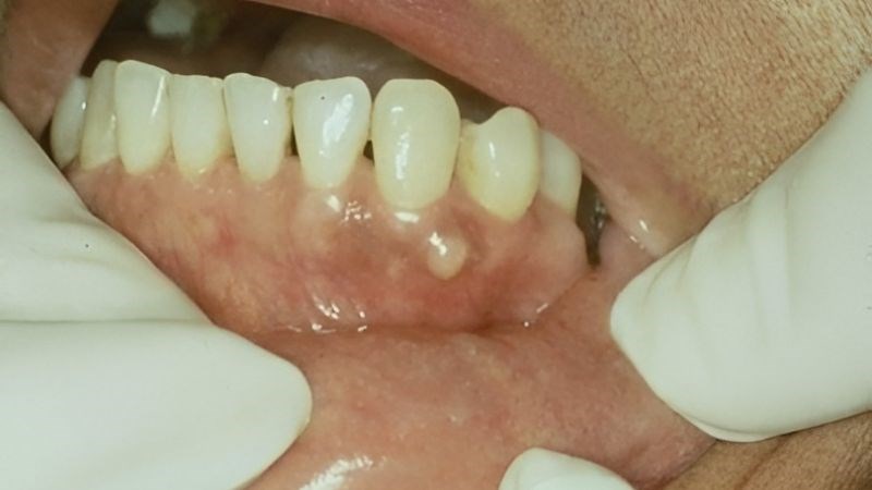 Triệu chứng của u răng thường bao gồm sưng, đau, rát, khó nuốt và khó nói