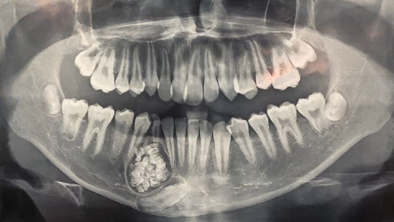 Việc chẩn đoán u răng thường dựa vào các phương pháp hình ảnh như chụp X-quang