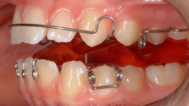 Sau khi loại bỏ u răng, việc chỉnh nha có thể được áp dụng để khắc phục các vấn đề về hàm răng
