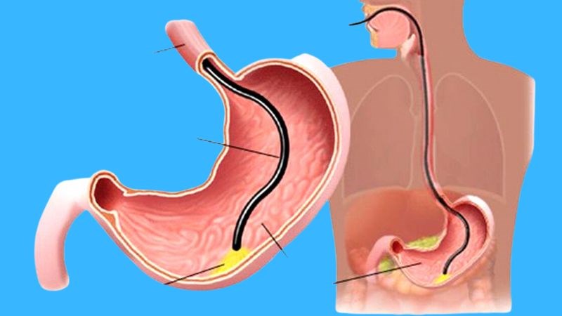 Nội soi dạ dày - thực quản giúp quan sát niêm mạc hang vị