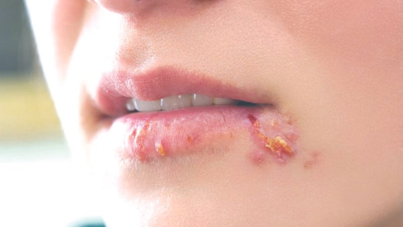 Hạ cam mềm do vi khuẩn Haemophilus ducreyi gây ra