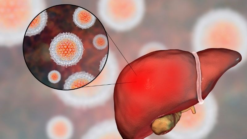 Nhiễm virus là một trong những nguyên nhân hàng đầu gây nên bệnh viêm gan cấp tính