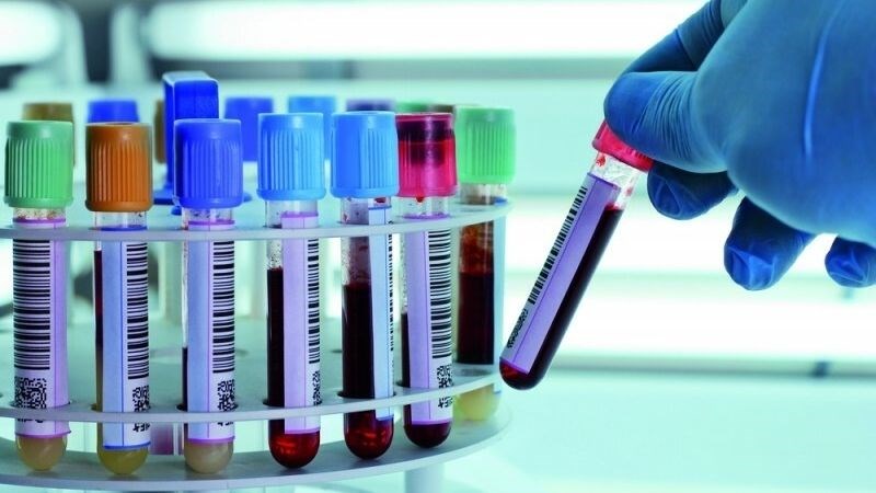 Làm xét nghiệm sinh hóa để chẩn đoán viêm gan cấp