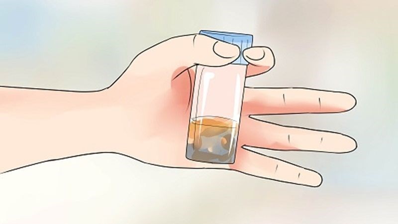 Xét nghiệm phân giúp tìm thấy trứng giun có trong phân